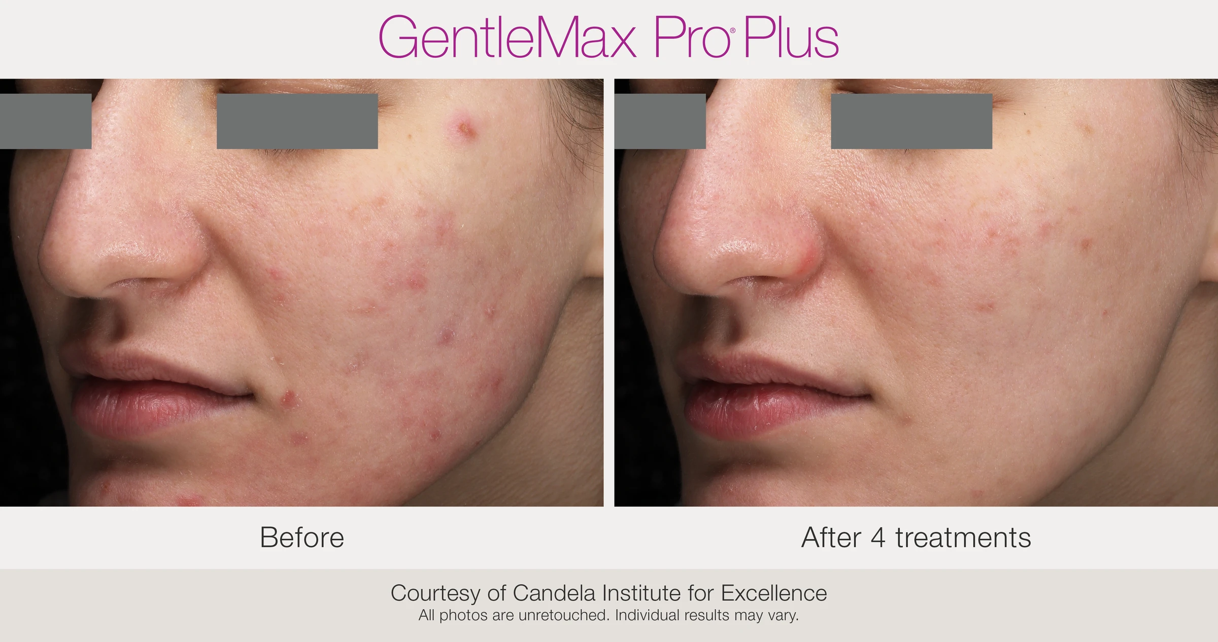 Cheek: before and after 4 treatments. GentleMax Pro Plus. Courtesy of Candela Institute for Excellence.