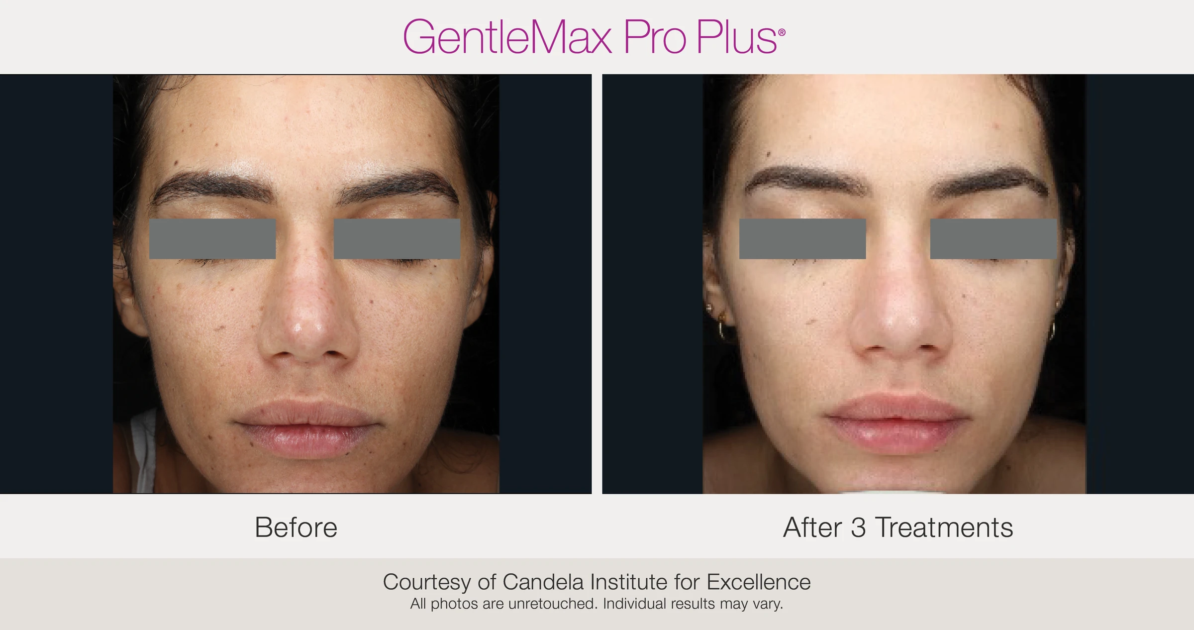 Face: before and after 3 treatments. GentleMax Pro Plus. Courtesy of Candela Institute for Excellence.