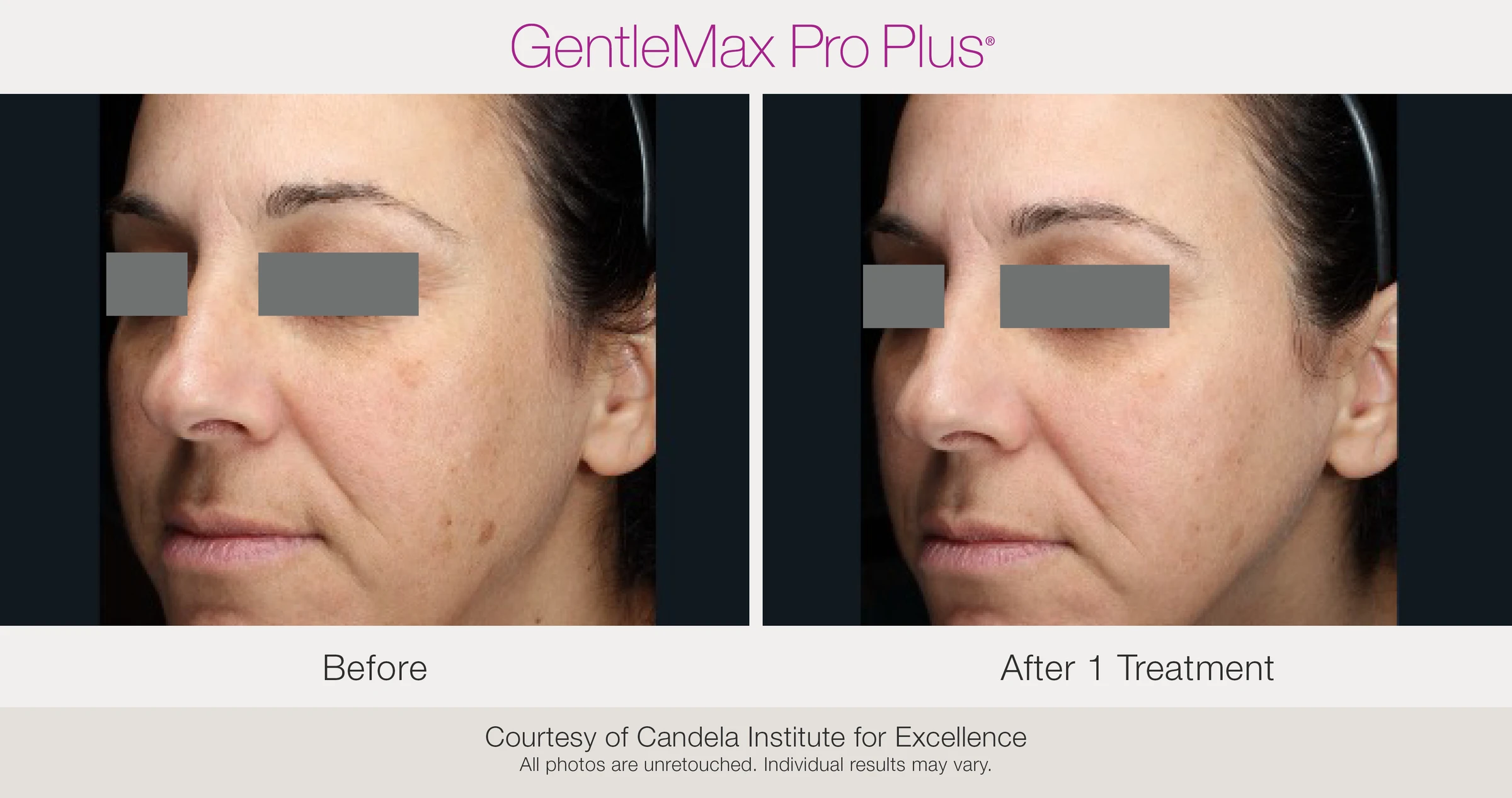 Face: before and after 1 treatment. GentleMax Pro Plus. Courtesy of Candela Institute for Excellence.