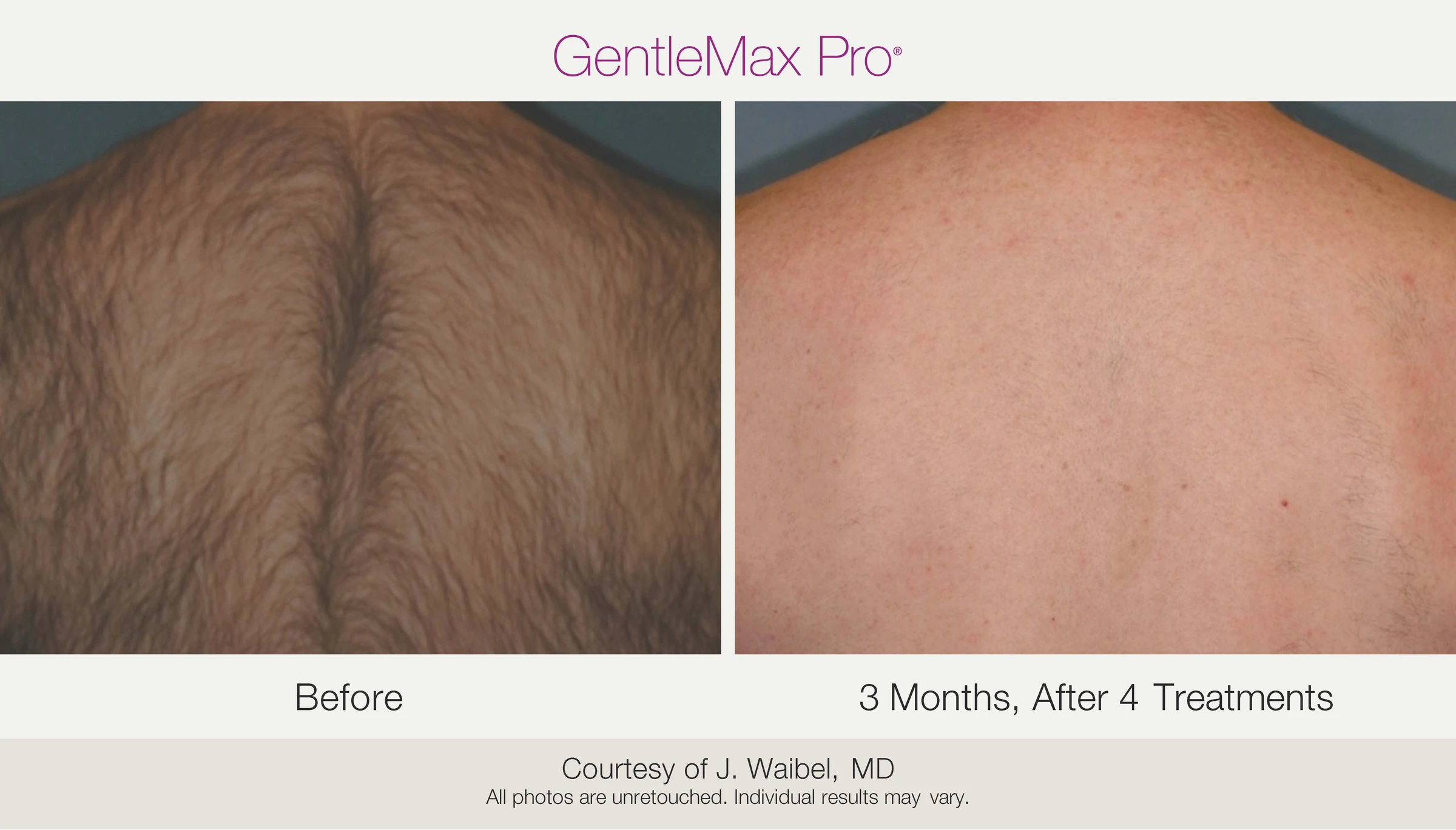 Back: before and 3 months after 4 treatments. GentleMax Pro. Courtesy of J. Waibel, MD.