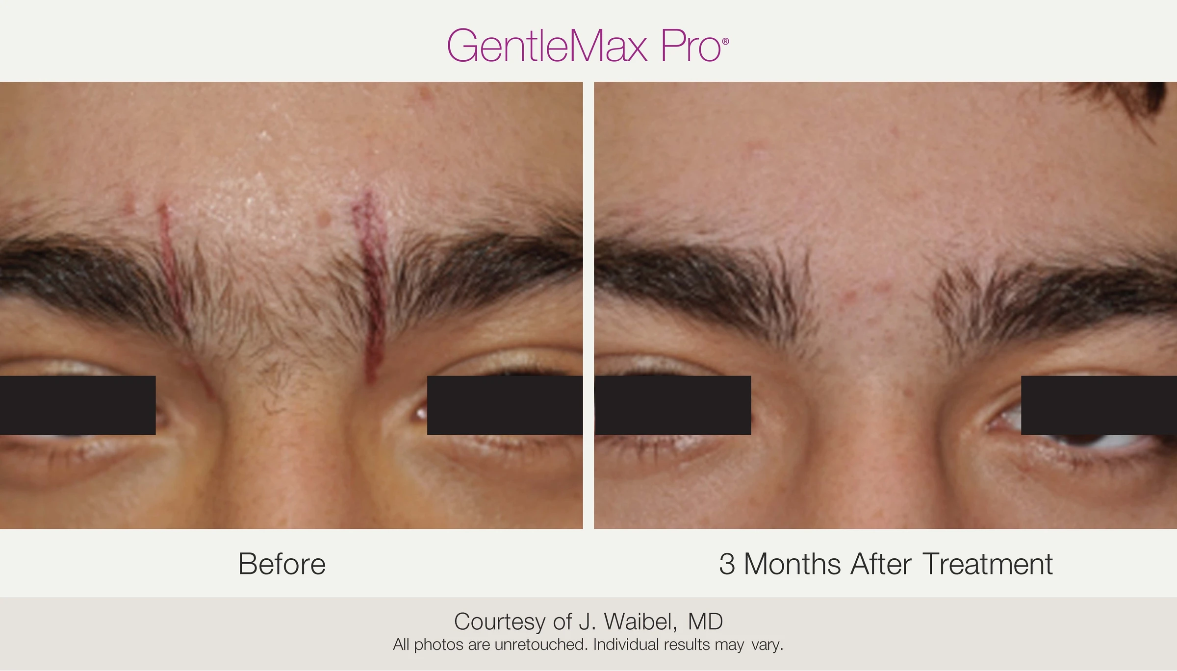 Between the eyebrows: before and 3 months after treatment. GentleMax Pro. Courtesy of J. Waibel, MD.