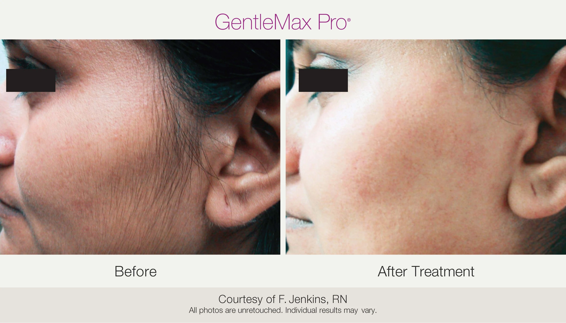 Facial hair: before and after treatment. GentleMax Pro. Courtesy of F. Jenkins, RN.
