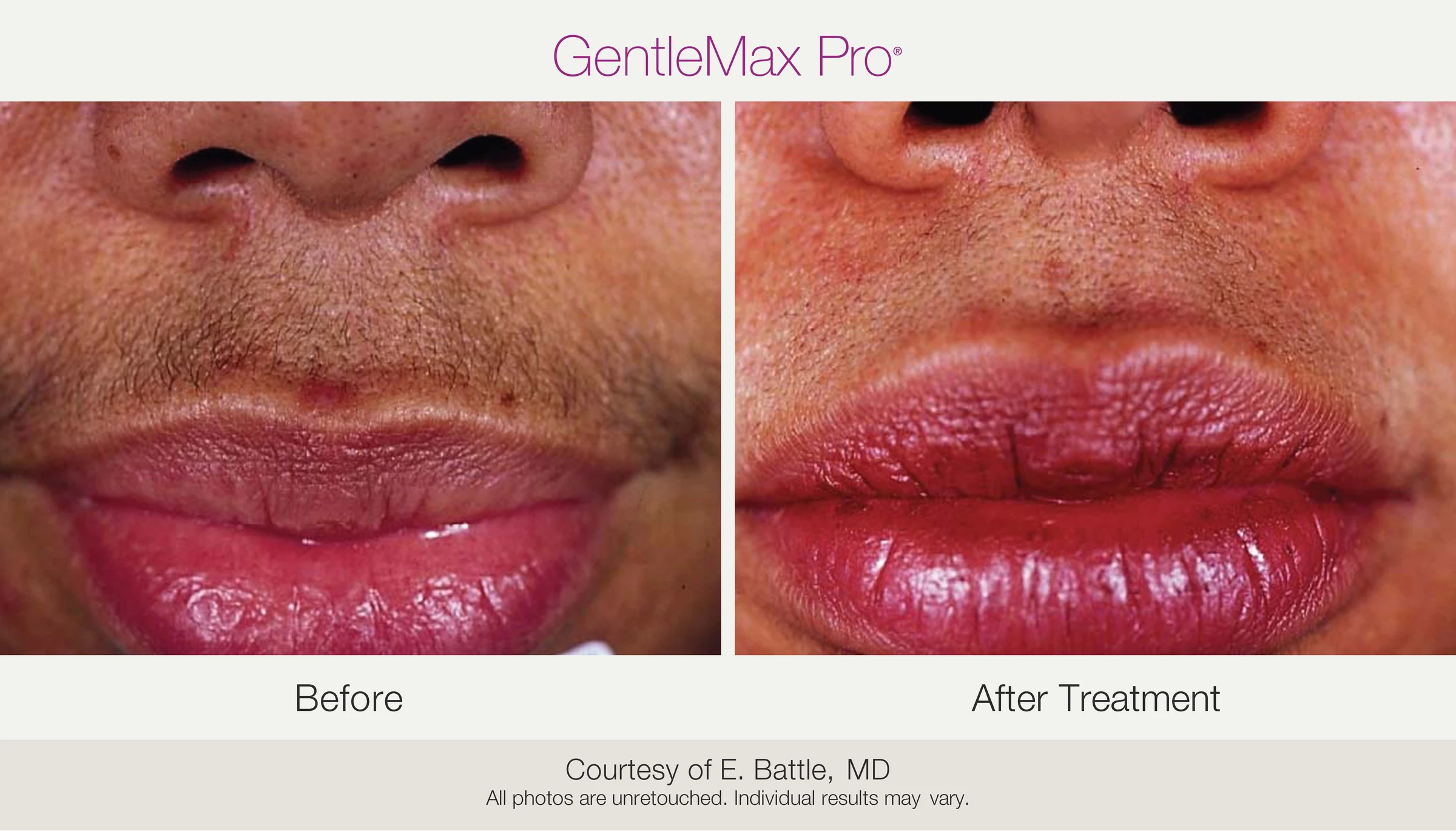 Upper lip: before and after treatment. GentleMax Pro. Courtesy of E. Battle, MD.