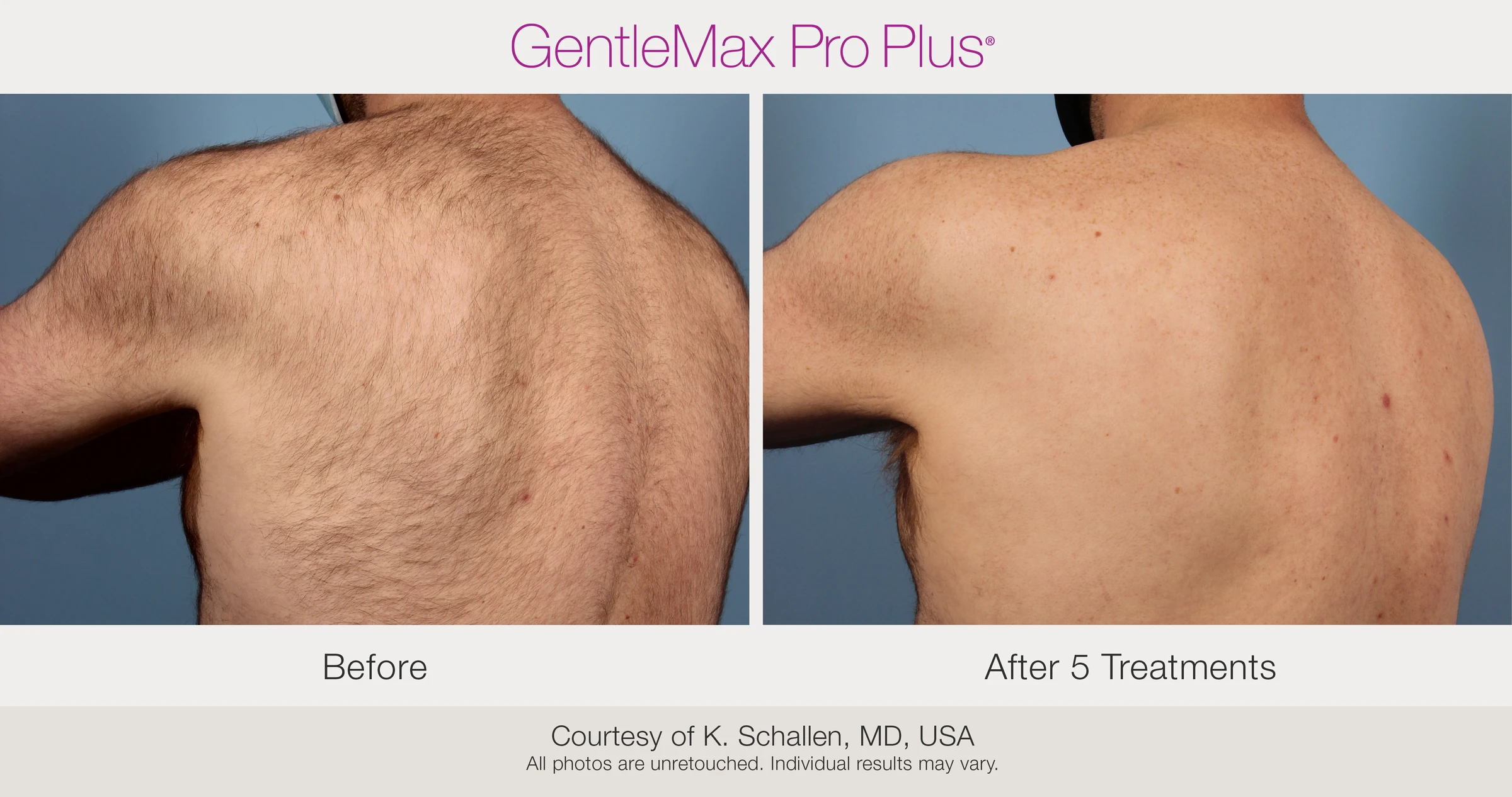 Back and shoulder: before and after 5 treatments. GentleMax Pro Plus. Courtesy of K. Schallen, MD, USA.