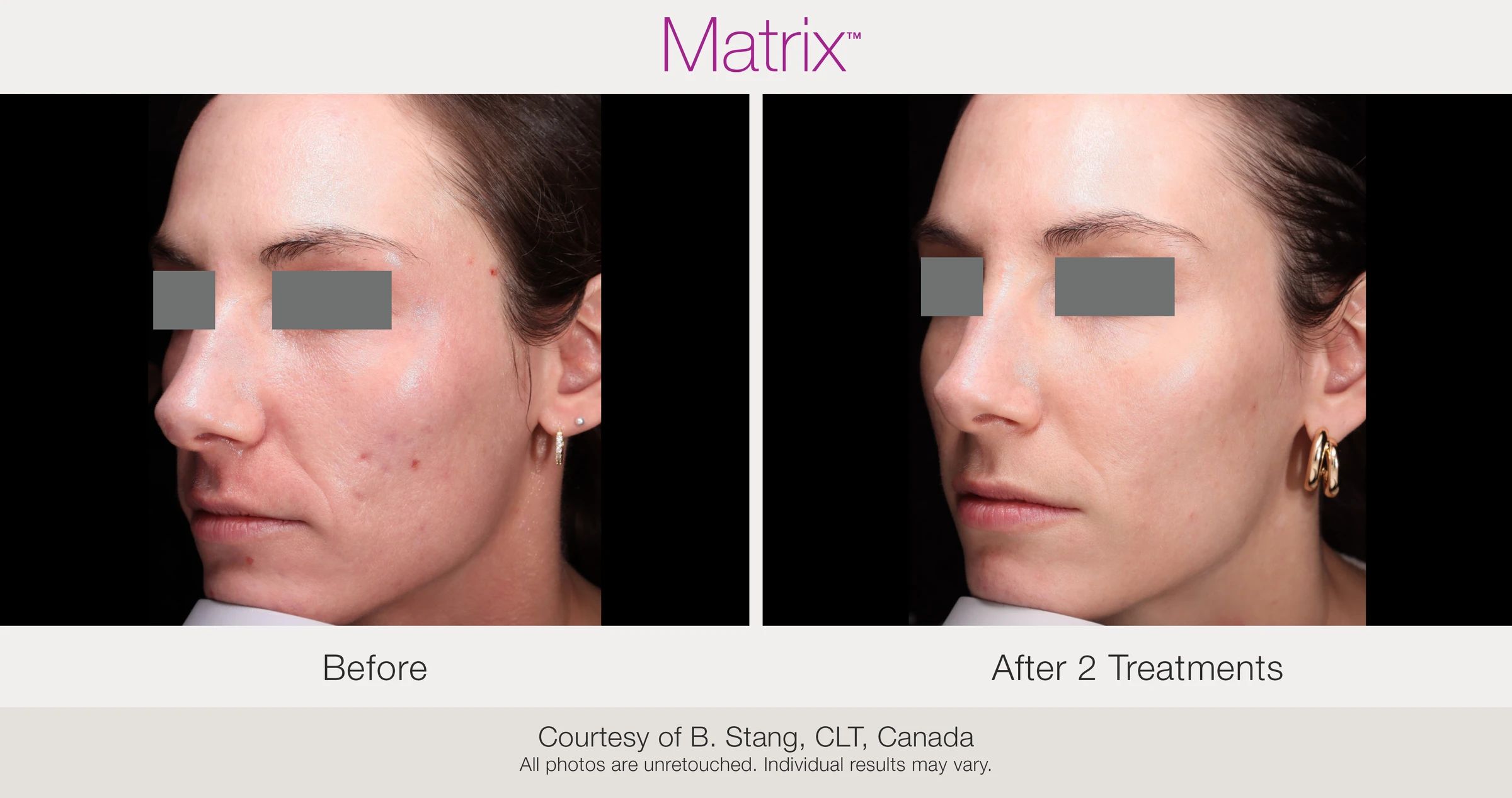 Before and after 2 RF microneedling treatments. Courtesy of B. Stang, CLT, Canada.