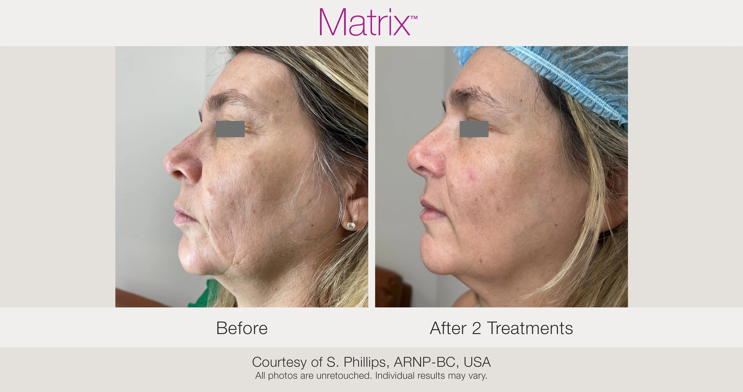 Before and after 2 RF microneedling treatments. Courtesy of S. Phillips, ARNP-BC, USA.