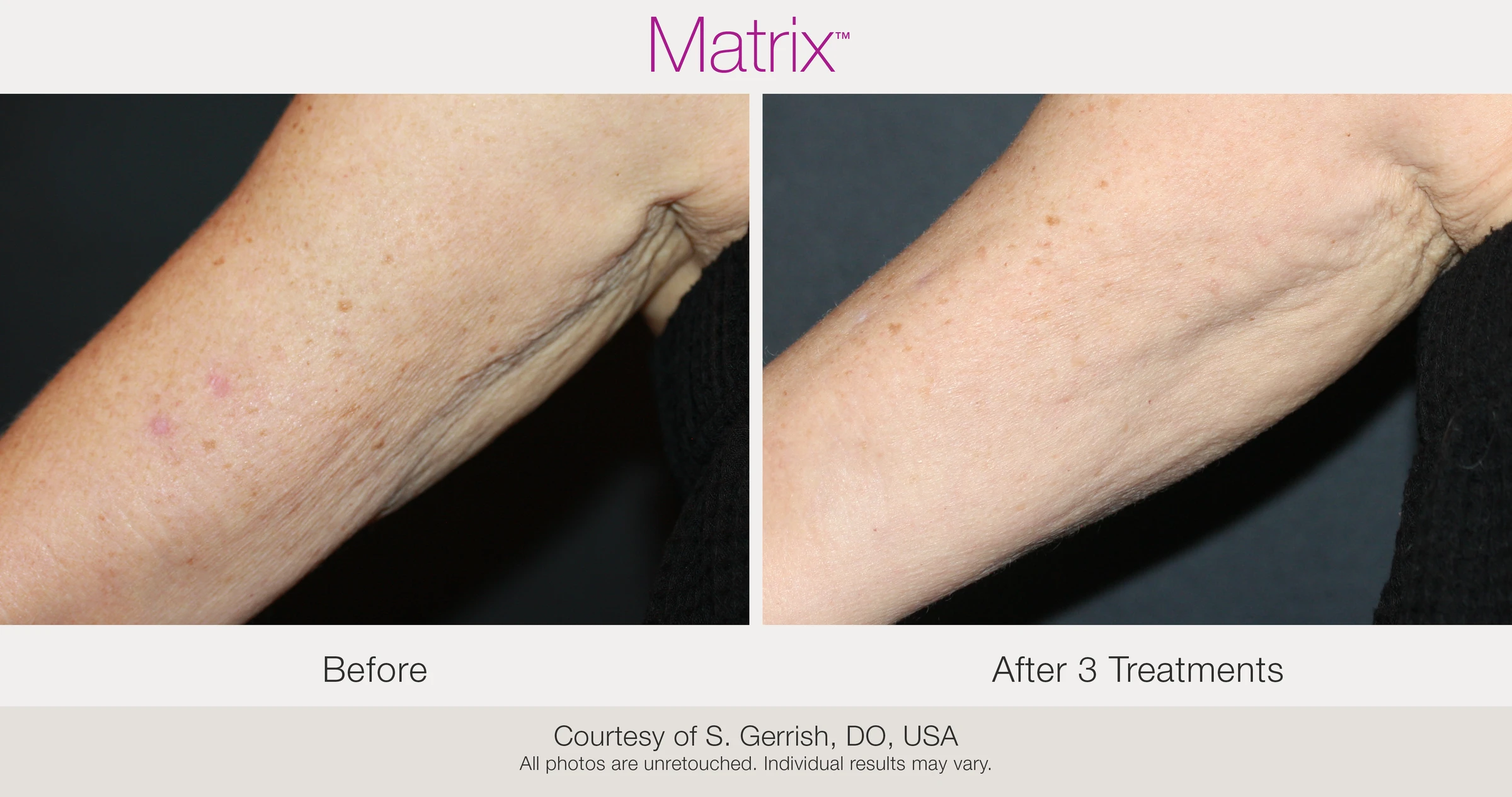 Before and after 3 RF microneedling treatments. Courtesy of S. Gerrish, DO, USA.