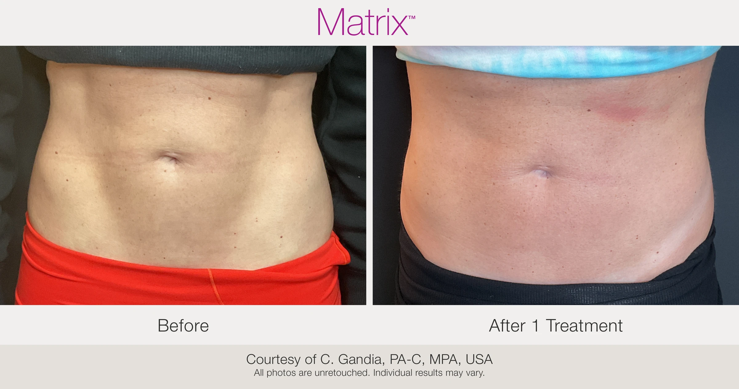 Before and after 1 RF microneedling treatment. Courtesy of C. Gandia, PA-C, MPA, USA.