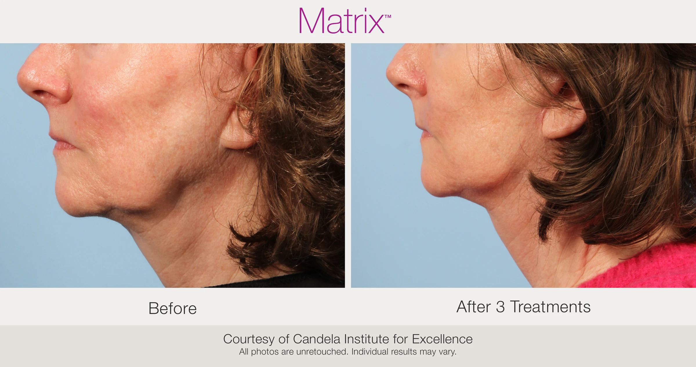 Before and after 3 RF microneedling treatments. Courtesy of Candela Institute for Excellence.