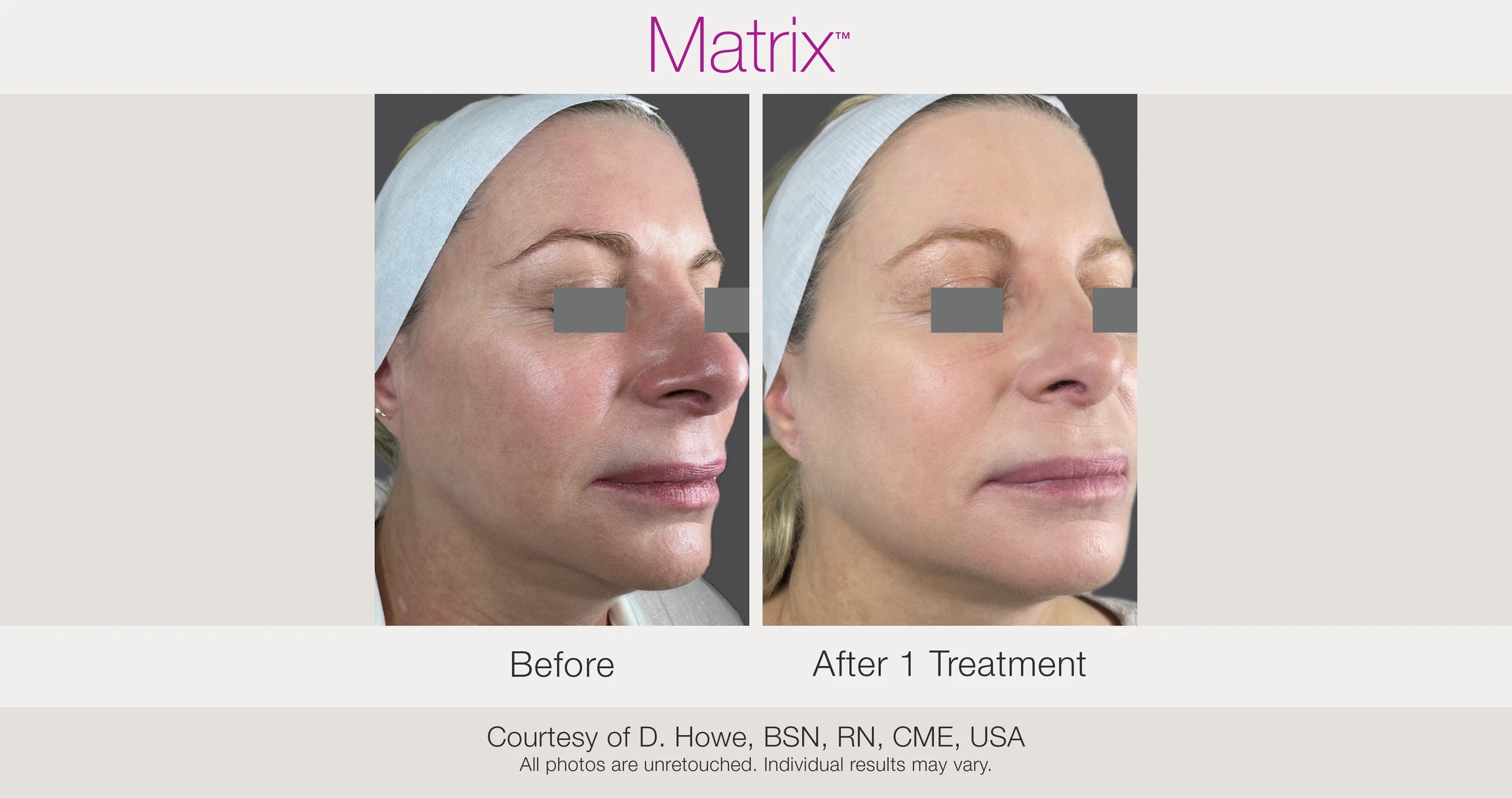 Before and after 1 RF microneedling treatment. Courtesy of D. Howe, BSN, RN, CME, USA.