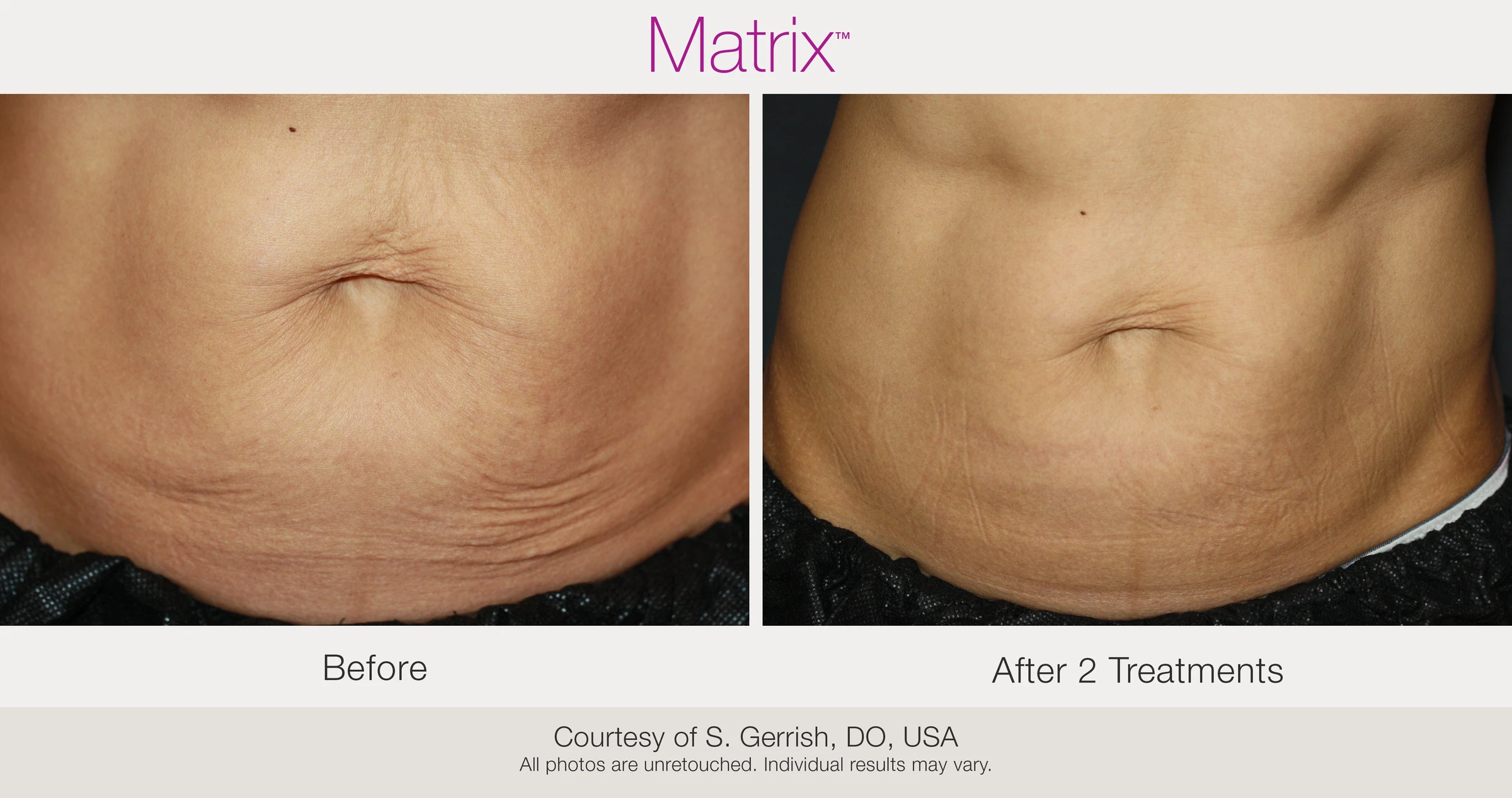 Before and after 2 RF microneedling treatments. Courtesy of S. Gerrish, DO, USA.