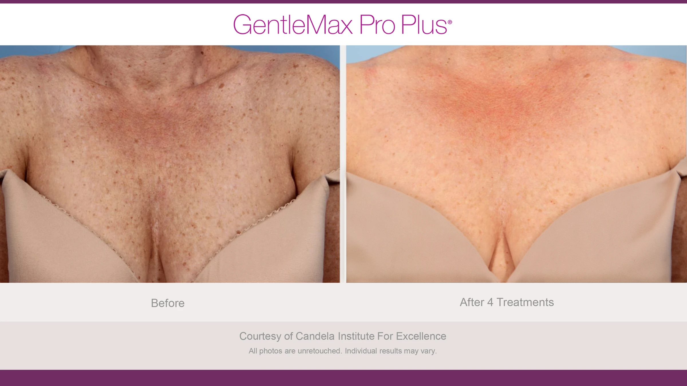 Chest: before and after 4 treatments. GentleMax Pro Plus. Courtesy of Candela Institute for Excellence.