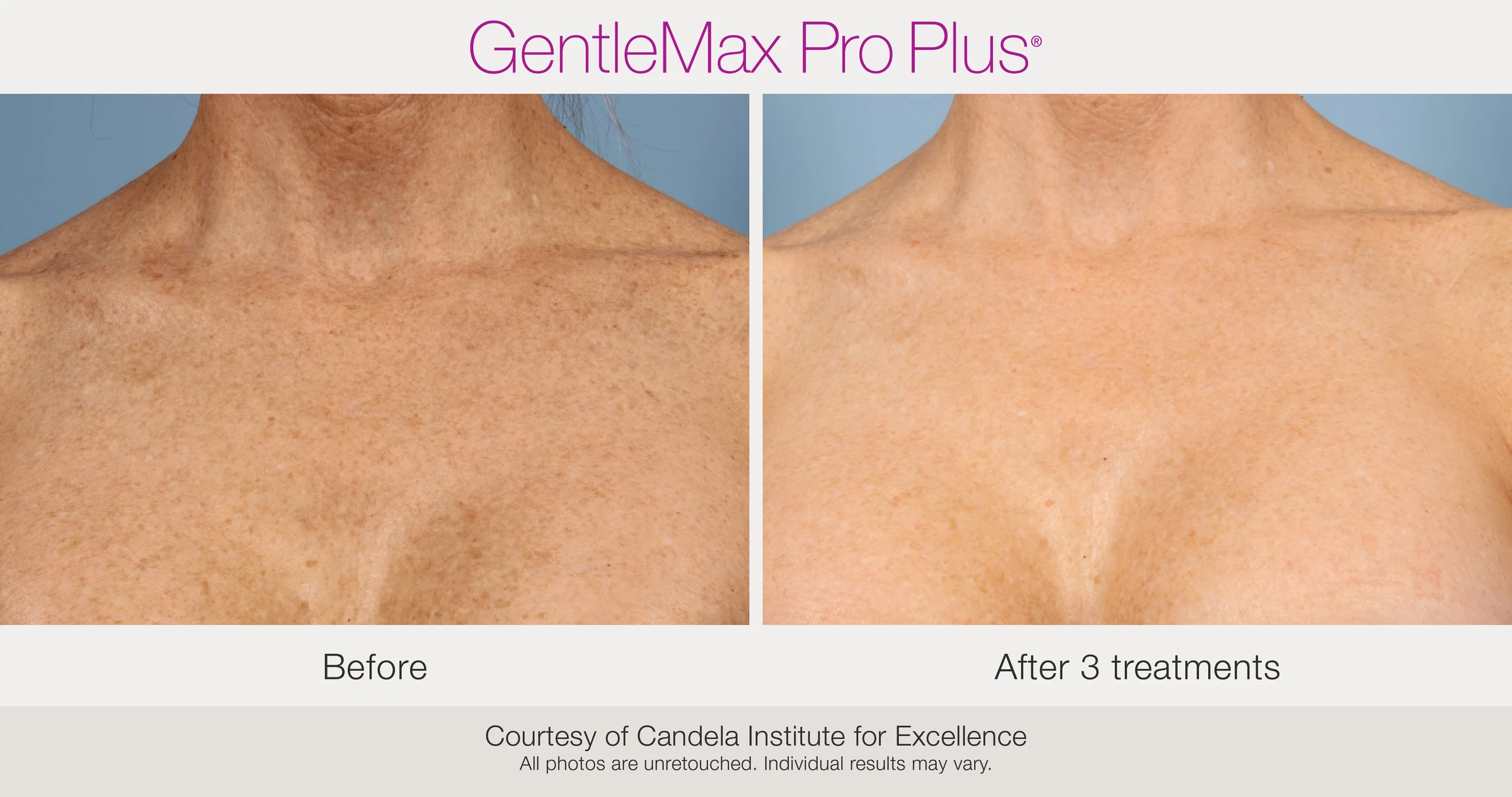 Chest: before and after 3 treatments. GentleMax Pro Plus. Courtesy of Candela Institute for Excellence.