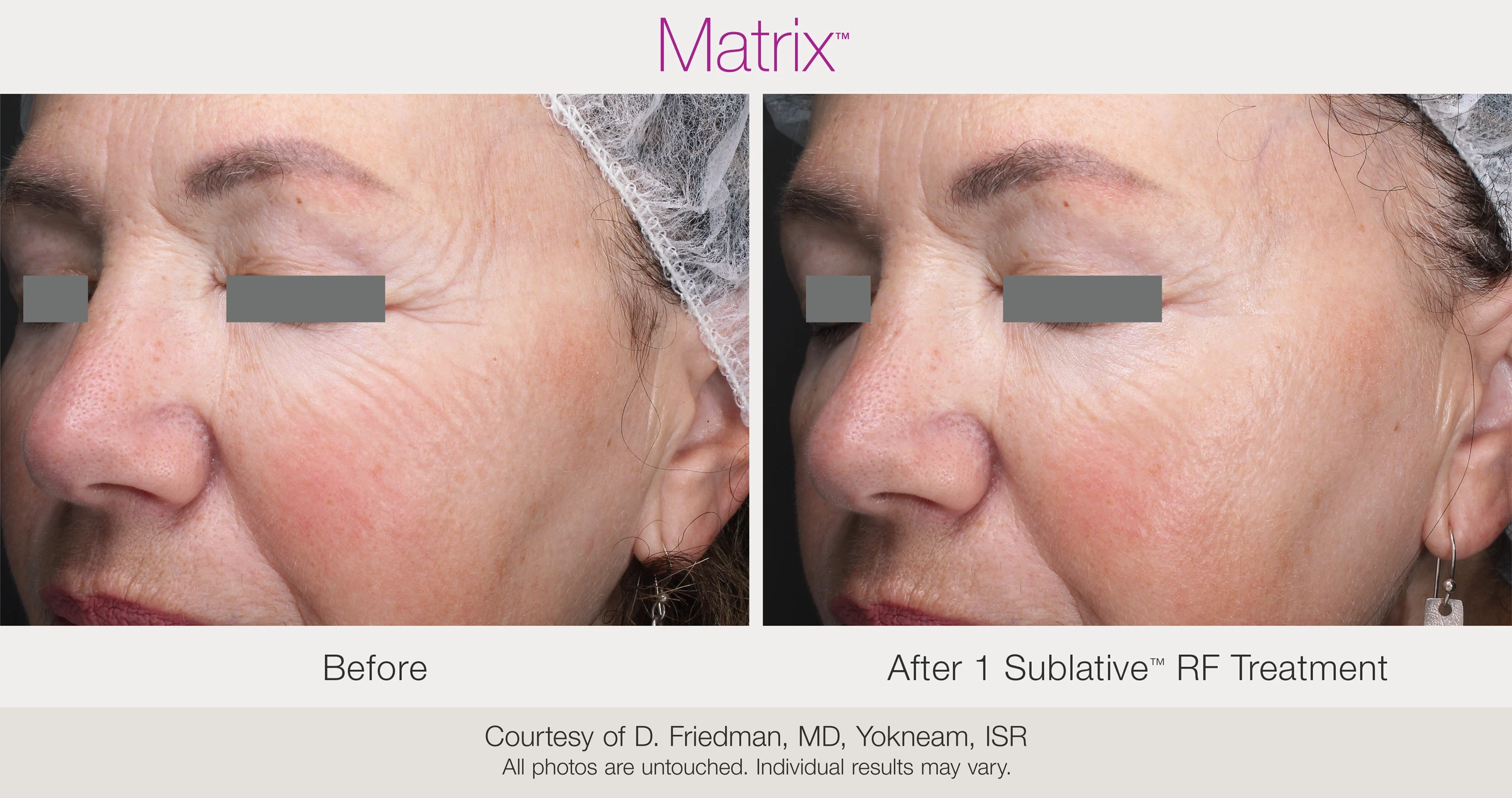 Before and after 1 Sublative RF treatment. Courtesy of D. Friedman, MD, Yokneam, ISR.