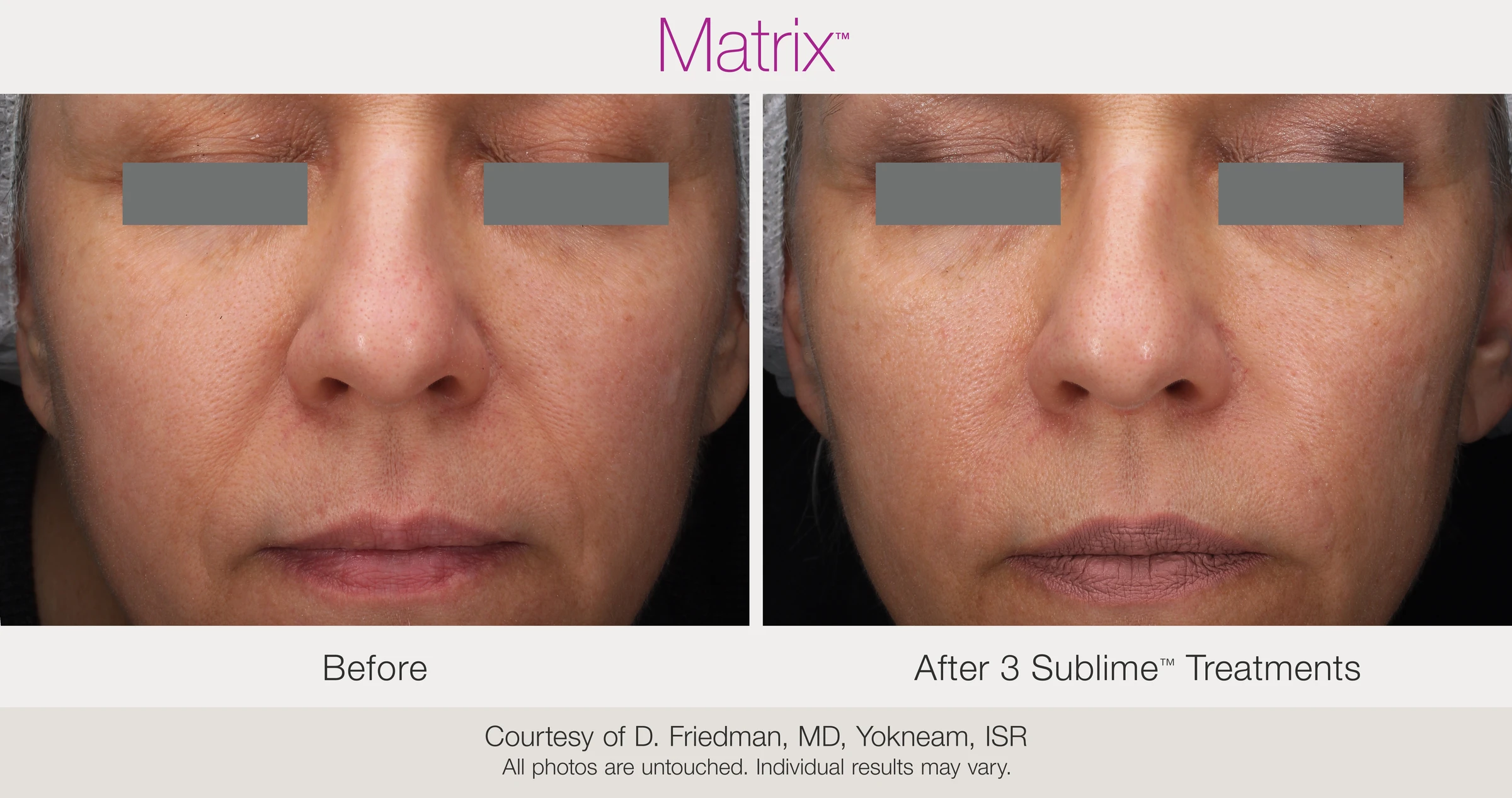 Before and after 3 Sublime treatments. Courtesy of D. Friedman, MD, Yokneam, ISR.